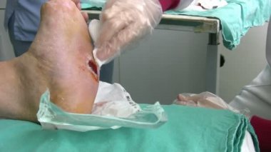 Diyabetik ayak yaralı