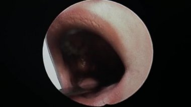 VINNYTSYA, UKRAINE - 4 Kasım 2020: gırtlak ve gırtlağın endoskopik muayenesi. Otolaryngologist 'in aleti. Endoskopi ve otolarengolojide manipülasyon için bir cihaz. Editör görüntüleri.