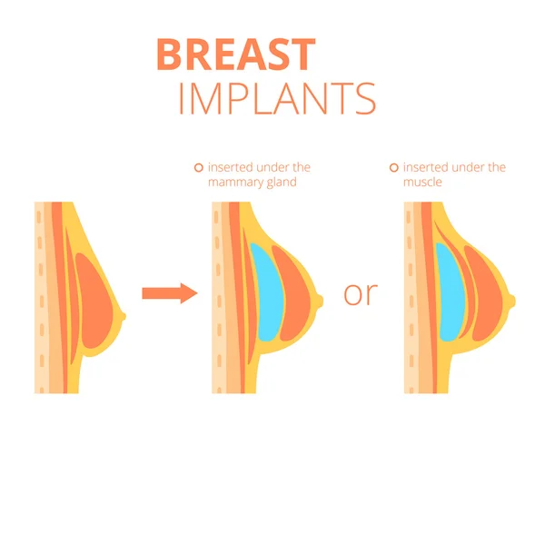 Infographies sur l'augmentation mammaire . — Image vectorielle