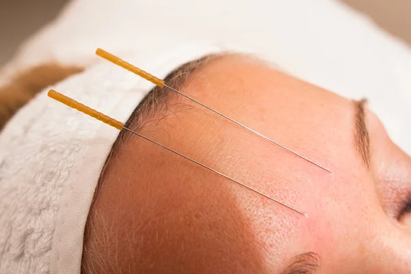 Thin needles inserted into the body at acupuncture points — Stock Photo, Image