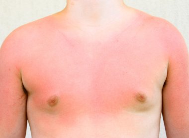 Yaz aylarında güneş yanığı