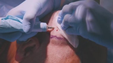 Kel saçtan saç nakli ameliyatı sırasında saç kökü birimlerini ayırmak için lateks eldivenli tanımlanamayan doktor ve asistan.