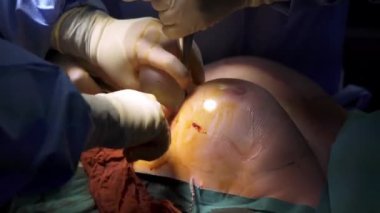 Ekin cerrahi ekibi kadınlara göğüs ameliyatı yapıyor.