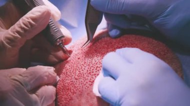 Kel saçtan saç nakli ameliyatı sırasında saç kökü birimlerini ayırmak için lateks eldivenli tanımlanamayan doktor ve asistan.