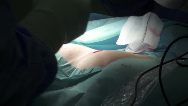 临床隆胸手术中 用钳和剪刀缝合切口 用胶乳手套割伤无法辨认的外科医生 — 图库视频影像