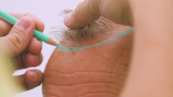 Nerozpoznatelný Lékař Pomocí Tužky Nakreslit Novou Linii Vlasů Hlavu Staršího — Stock video