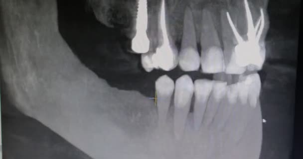 Fechar Raio Dentes Paciente Tela Monitor Clínica Dentária — Vídeo de Stock