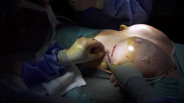 Anonymous Doctor Applying Stitches Breast Unrecognizable Patient Performing Plastic Surgery — Stock Video