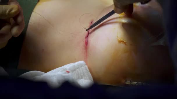 Haut Médecin Anonyme Appliquant Des Points Suture Sous Sein Patient — Video