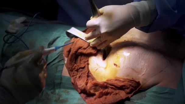 Crop Kirurgiska Team Gör Bröstkirurgi Till Kvinna — Stockvideo