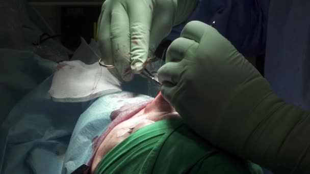 391 Rhinoplasty surgery Videos, Royalty-free Stock Rhinoplasty surgery  Footage | Depositphotos