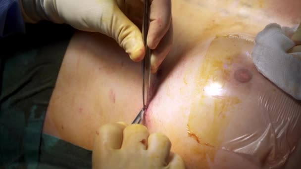 Från Ovan Anonym Läkare Tillämpa Stygn Bröstet Oigenkännliga Patienten Efter — Stockvideo