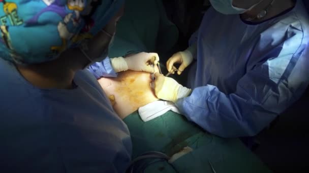 从上至下 医生在临床实施整形手术后 在无法辨认的病人乳房下缝针 — 图库视频影像