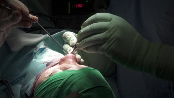 医院鼻腔整形手术中鼻腔上戴防护手套缝合创面的隐形外科医生 — 图库视频影像