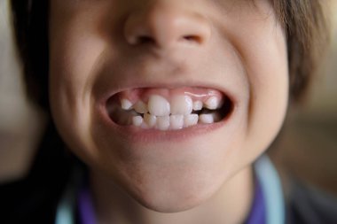 Çocuk mutlu bir şekilde dişlerini gösteriyor, birincilikten kalıcı dişlere geçiyor.