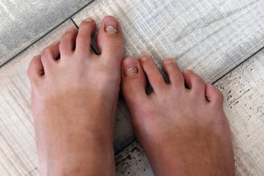 Dişi ayağın yakın çekimi. Tırnaklar hastalıktan zarar görmüş. Tekrar uzayın. Hasarlı cilt ve küçük parmak