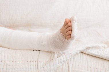 Kırık bacak. Ayağındaki alçıya yakın çekim. Kas onarma ve güçlendirme egzersizleri. Kemiklerde hasar var. Acil servisteki bir cerrahın tıbbi bakımı.