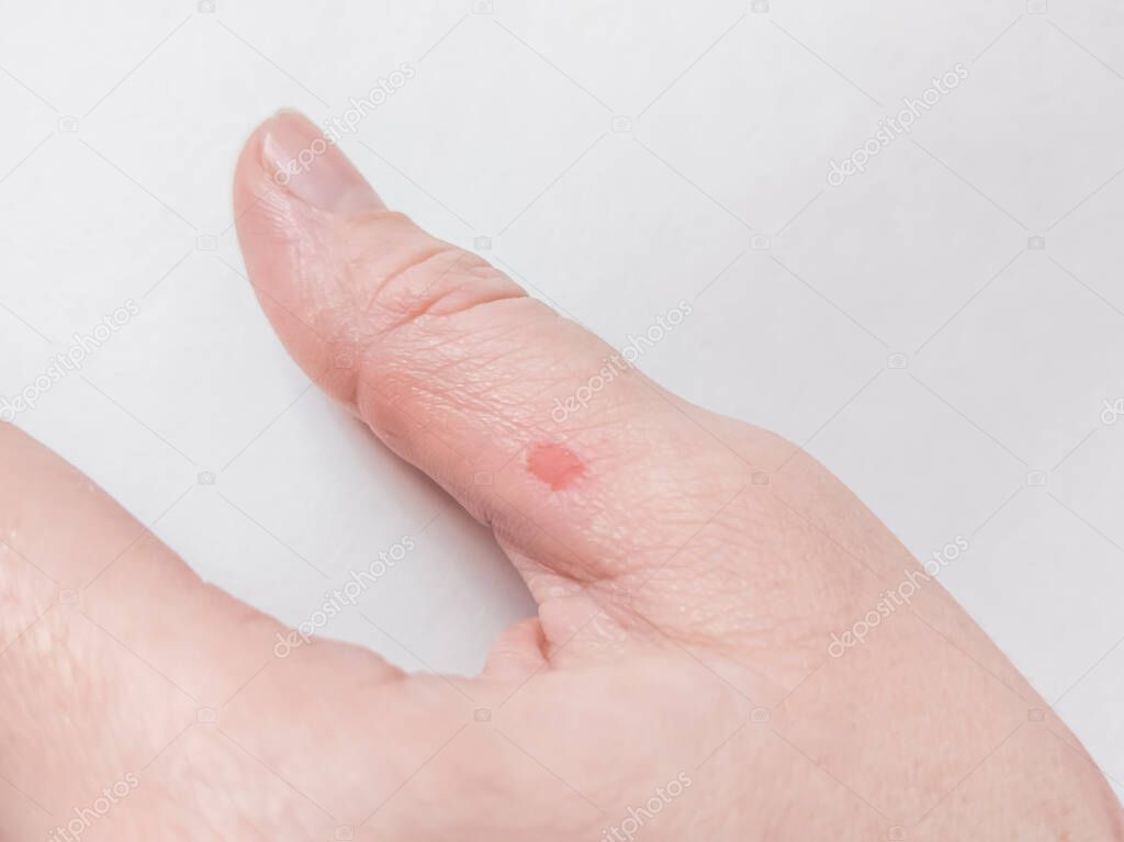 Close up of a popped blister in a caucasian person's thumb against a white background