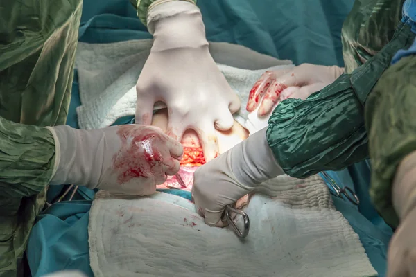 Parto en el quirófano cirugía de cesárea — Foto de Stock