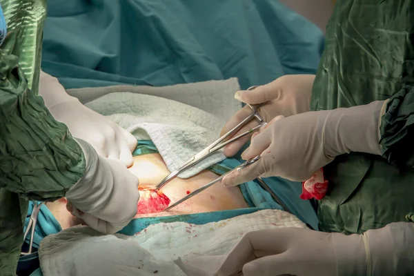 Parto en el quirófano cirugía de cesárea — Foto de Stock