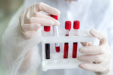 Bir hemşirenin ellerinde hastanın kanı olan test tüpü.