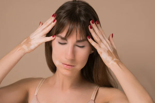 Uma jovem mulher de cabelos longos com pigmentação da pele que sofre de uma dor de cabeça — Fotografia de Stock