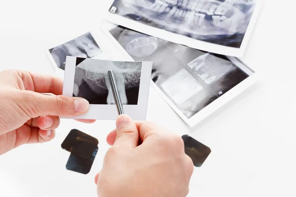 Immagine dente malato, gengive — Foto Stock