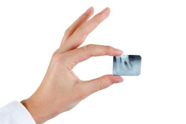 X-ışını periodontitis diş. 