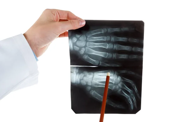 X-ray lidské ruky — Stock fotografie