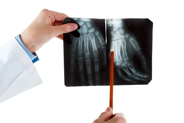 Radiografia della mano umana — Foto Stock