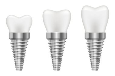 Diş implantı vektör tasarımı çizimi beyaz arkaplanda izole edildi