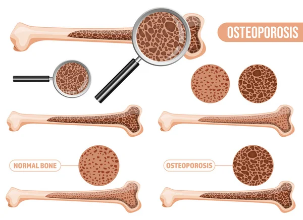 Osteoporoz vektör tasarımı çizimi beyaz arkaplanda izole edildi