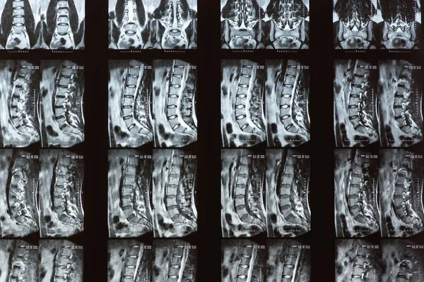 Bel bölgesinin MR görüntüsü. Teşhisler. Sağlık.