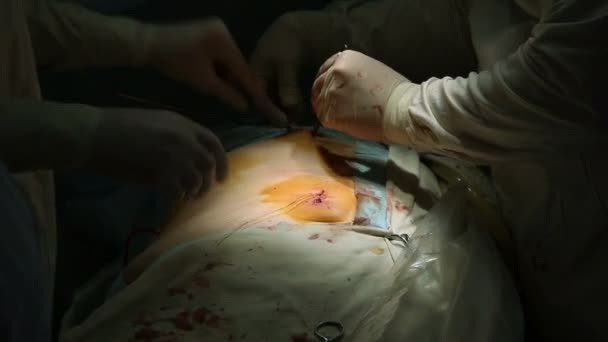 Хирург зашивает рану после операции — стоковое видео