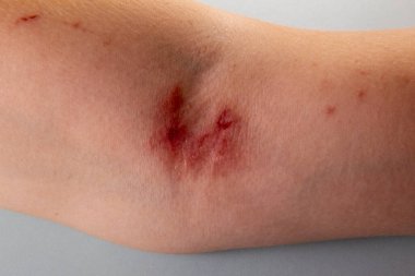 Ot yanığı Borshchevik Heracleum, kolundan yaralanmış..