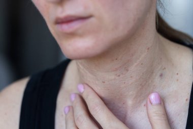 Biorevitalizasyon işleminden sonra derisi sorunlu bir kadın boynu. - Yakın çekim. Güzellik iğneleri