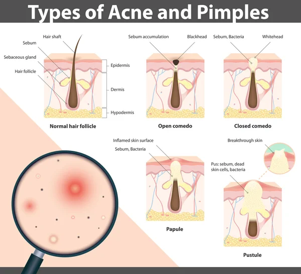 Tipi di acne e brufoli, illustrazione vettoriale — Vettoriale Stock