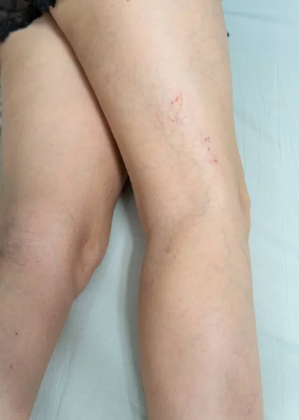 Retrait des vaisseaux sanguins par chirurgie au laser, beauté du traitement des jambes, anatomie de la découpe. Aide à risque derme, télangiectases esthétiques physiques — Photo