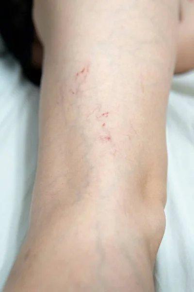 Removal of blood vessels by laser vessel surgery, leg problem pressure health beauty, veins Help risk enlarged, tortuous telangiectases physical — стоковое фото