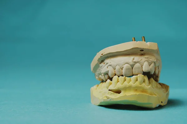 Odlew Krzywych Zębów Jasnoniebieskim Tle — Zdjęcie stockowe