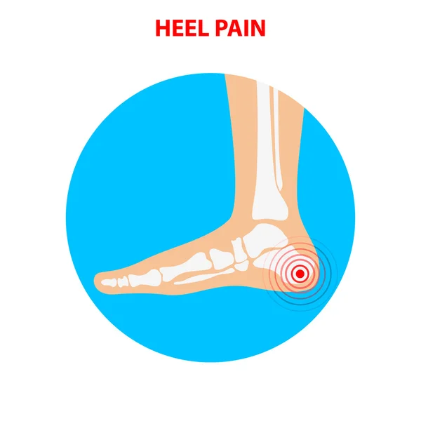 Dor no calcanhar. Ícone da articulação do tornozelo humano. Cuidados com os pés. Vector doente — Vetor de Stock