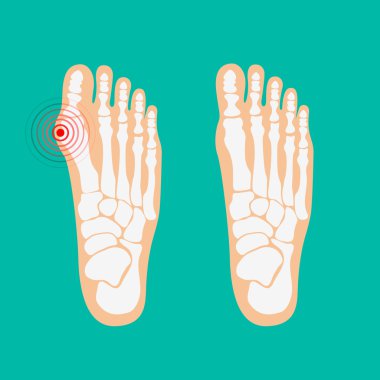Valgus deformity of the big toe. Foot health care. clipart