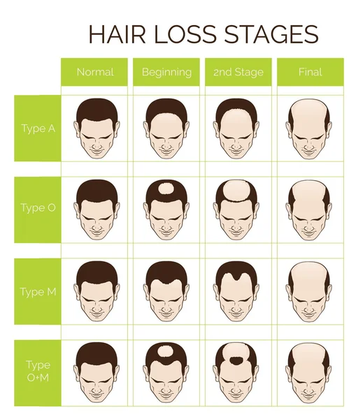 Stades et types de perte de cheveux pour hommes — Image vectorielle