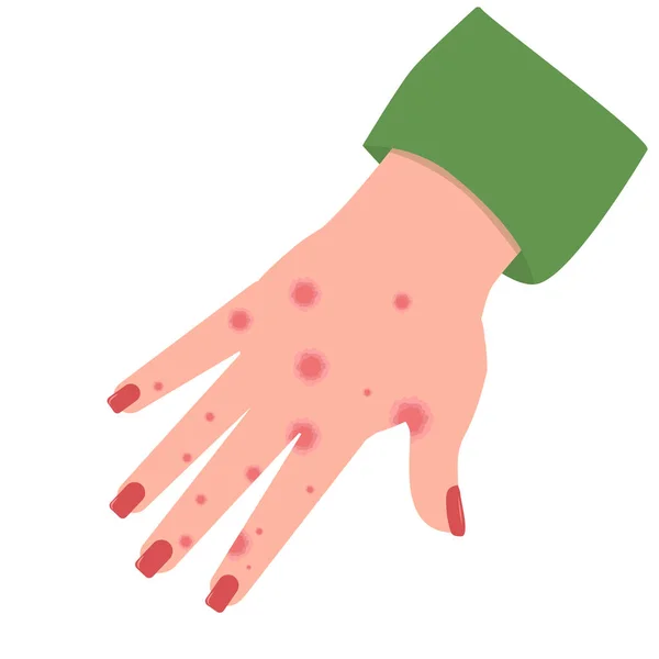 Illustrazione Vettoriale Una Mano Con Macchie Eczema Dermatite Contatto Isolata — Vettoriale Stock