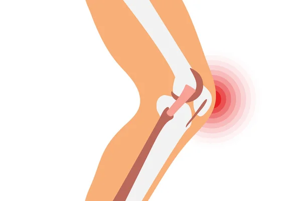 Ilustración Del Dolor Rodilla Círculo Dolor Una Articulación Rodilla Concepto — Archivo Imágenes Vectoriales