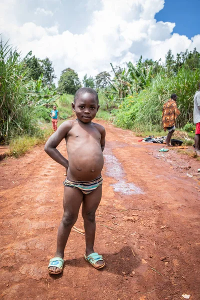 Afrikalı çocuk Kwashiorkor 'dan muzdarip. Karnı yetersiz beslenme yüzünden şişmiş..