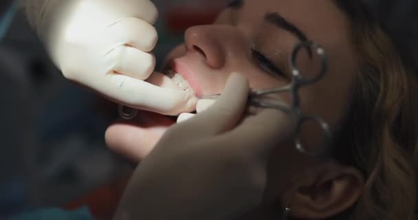 Ortodontista váže vazy na rovnátka pacientů — Stock video