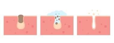 Cleaning clogged pores process flat illustration. Blackheads removal, skin cleaning foam, skincare. Can be used for topics like cosmetology, cosmetics. Shrinking and minimaizing face pores concept clipart