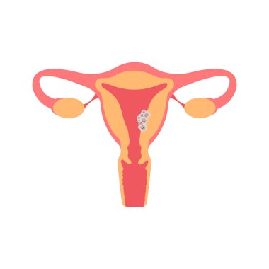 Rahim kanseri düz çizimi. Doğurganlık, insan anatomisi, kadın üreme sistemi. Hastalık, jinekoloji, onkoloji. Rahim dokusunda tümör hücreleri.