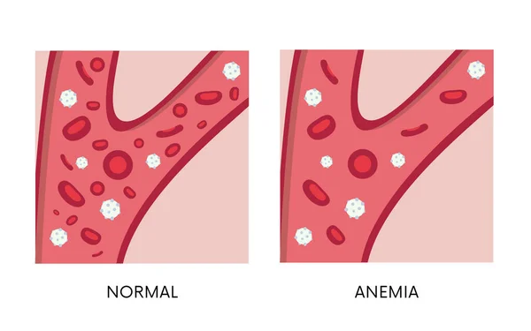 Cantidad Normal Anemia Glóbulos Rojos Sangre Ilustración Plana Anemia Por — Vector de stock